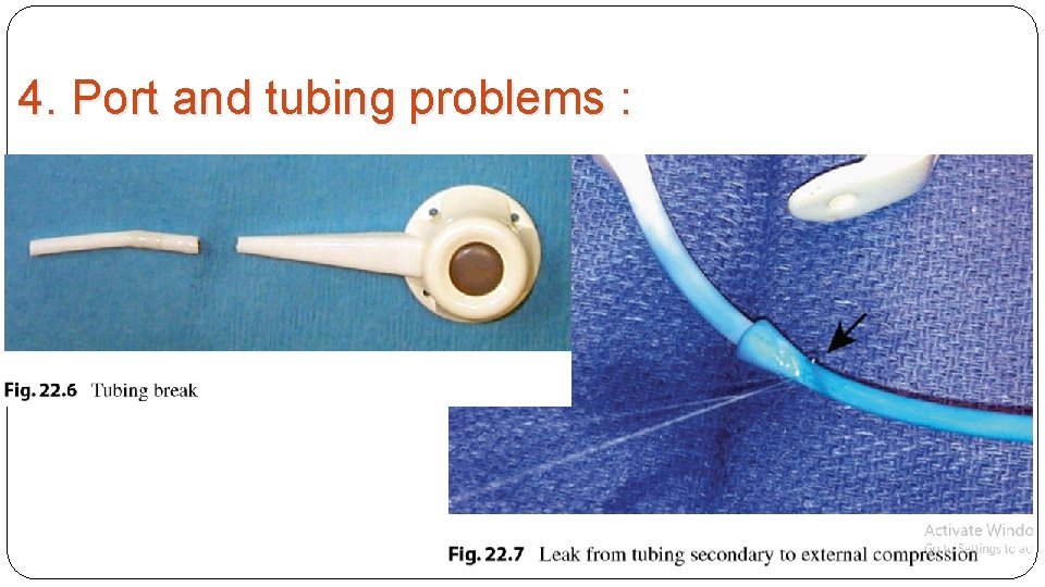4. Port and tubing problems : 