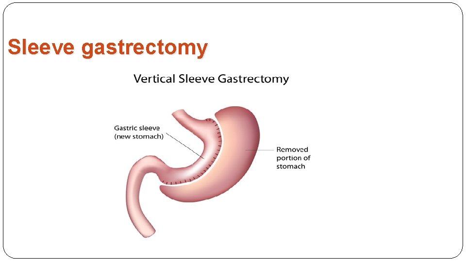Sleeve gastrectomy 