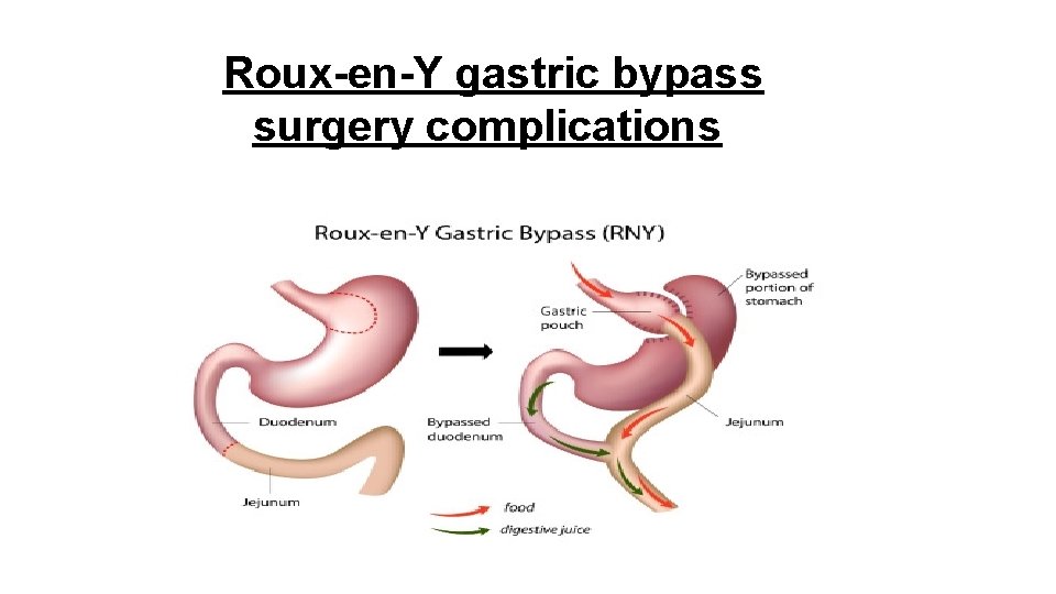 Roux-en-Y gastric bypass surgery complications 