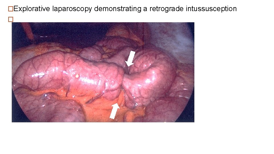 �Explorative laparoscopy demonstrating a retrograde intussusception � 