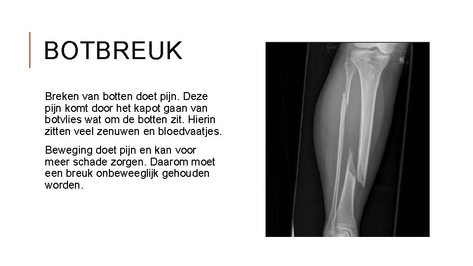 BOTBREUK Breken van botten doet pijn. Deze pijn komt door het kapot gaan van