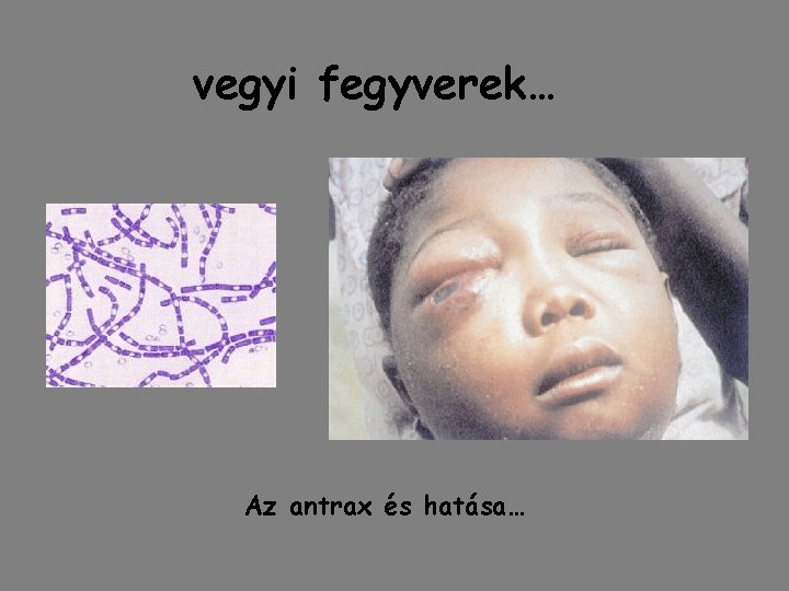 vegyi fegyverek… Az antrax és hatása… vegyi fegyverek… Az antrax és hatása…
