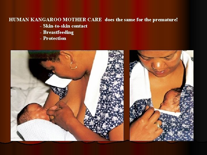 HUMAN KANGAROO MOTHER CARE does the same for the premature! - Skin-to-skin contact -