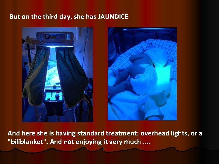 But on the third day, she has JAUNDICE And here she is having standard