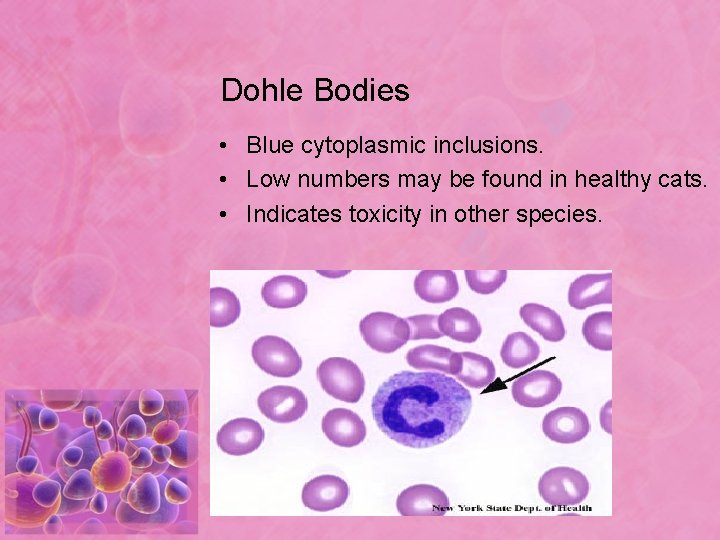 Dohle Bodies • Blue cytoplasmic inclusions. • Low numbers may be found in healthy