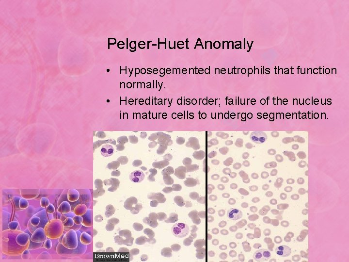 Pelger-Huet Anomaly • Hyposegemented neutrophils that function normally. • Hereditary disorder; failure of the