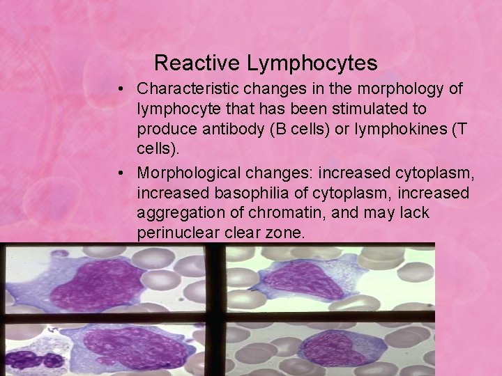 Reactive Lymphocytes • Characteristic changes in the morphology of lymphocyte that has been stimulated