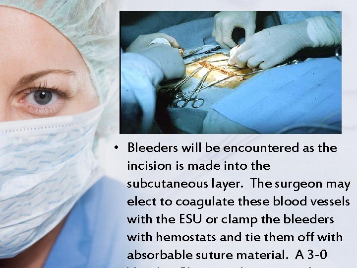  • Bleeders will be encountered as the incision is made into the subcutaneous