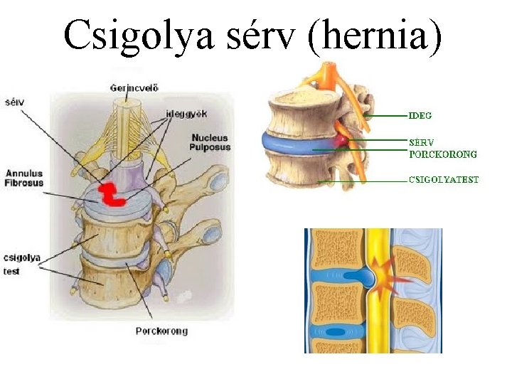 Csigolya sérv (hernia) 