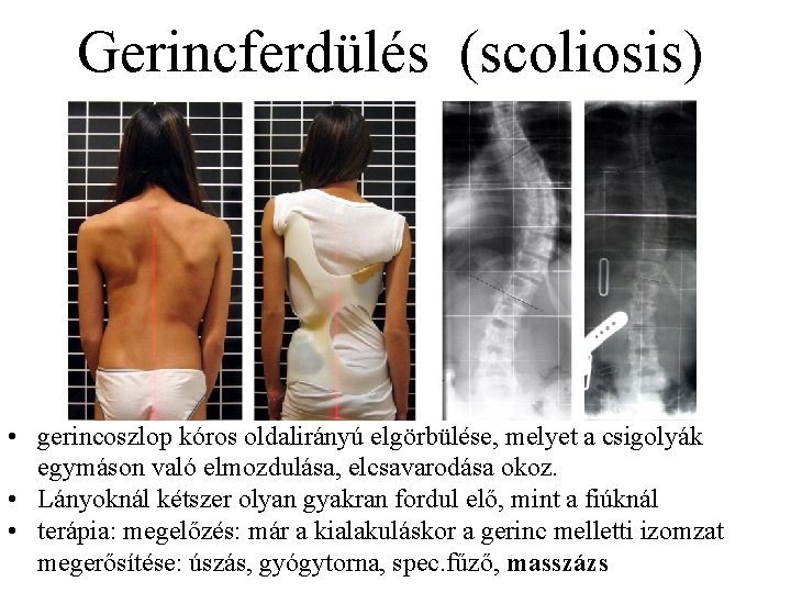 Gerincferdülés (scoliosis) • gerincoszlop kóros oldalirányú elgörbülése, melyet a csigolyák egymáson való elmozdulása, elcsavarodása