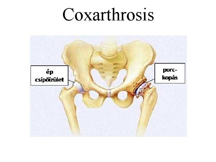 Coxarthrosis 