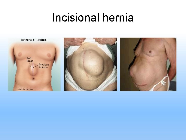 Incisional hernia 