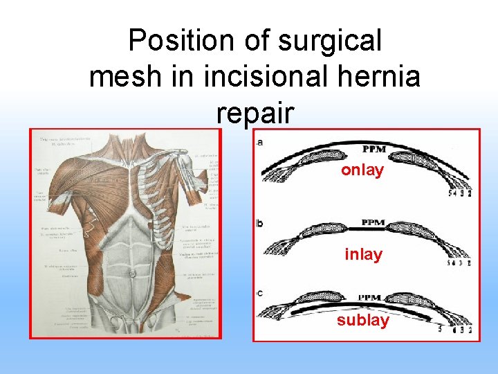 Position of surgical mesh in incisional hernia repair onlay inlay sublay 