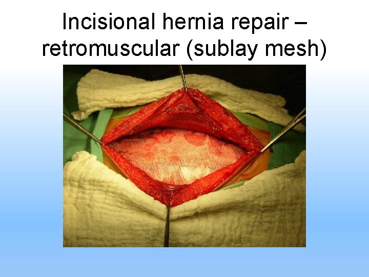 Incisional hernia repair – retromuscular (sublay mesh) 