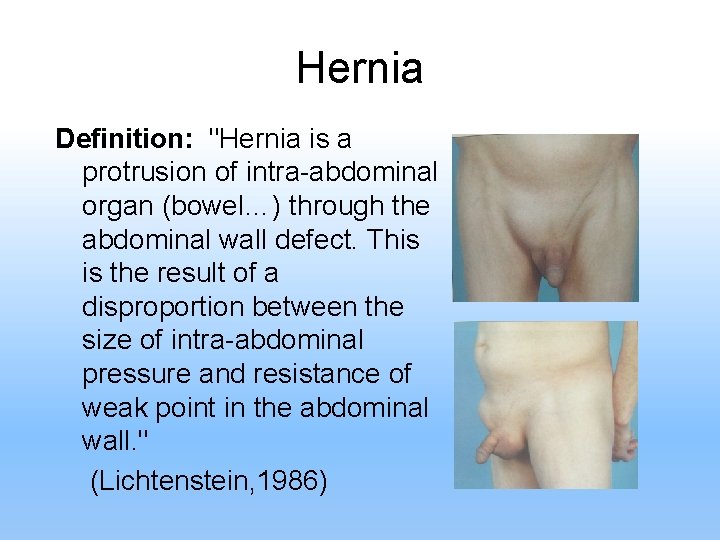 Hernia Definition: "Hernia is a protrusion of intra-abdominal organ (bowel…) through the abdominal wall