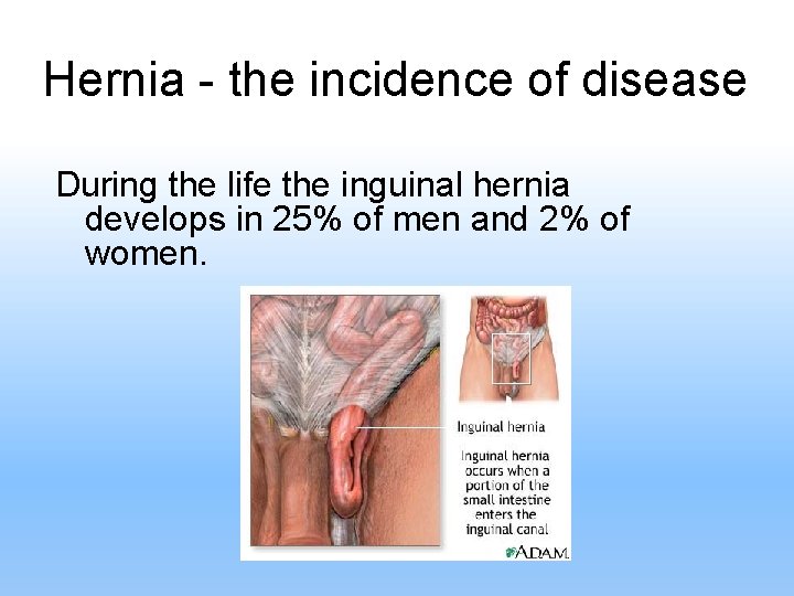 Hernia - the incidence of disease During the life the inguinal hernia develops in