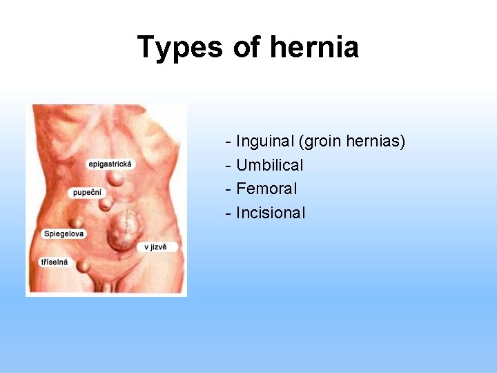Types of hernia - Inguinal (groin hernias) - Umbilical - Femoral - Incisional 