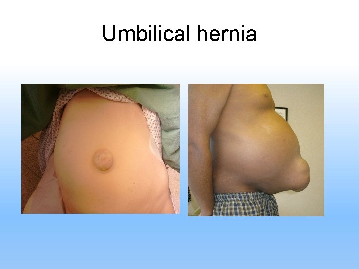 Umbilical hernia 