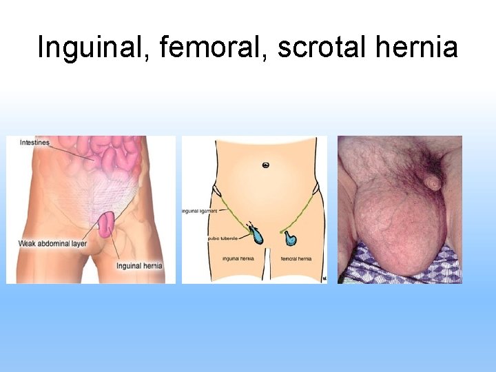 Inguinal, femoral, scrotal hernia 