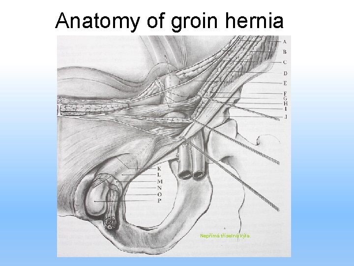 Anatomy of groin hernia Nepřímá tříselná kýla 