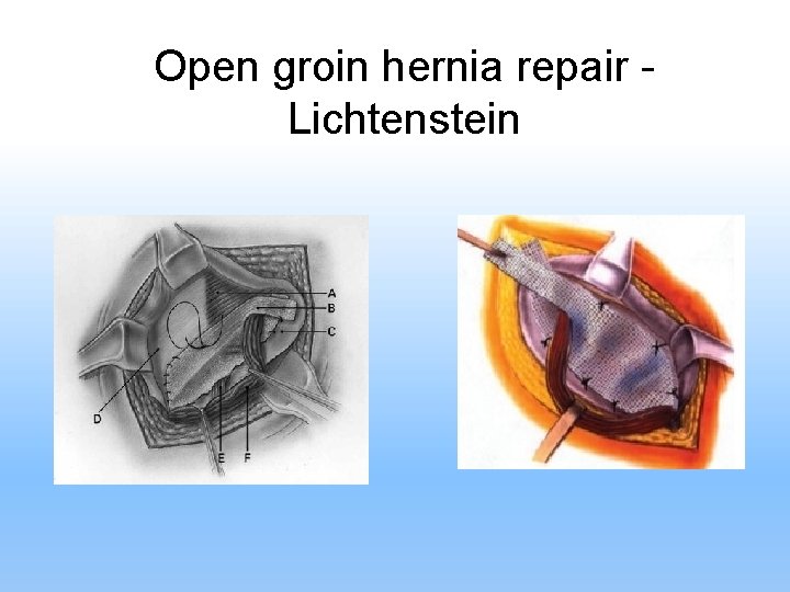 Open groin hernia repair Lichtenstein . 