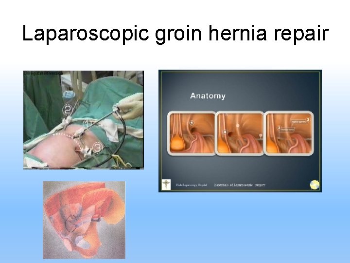 Laparoscopic groin hernia repair 