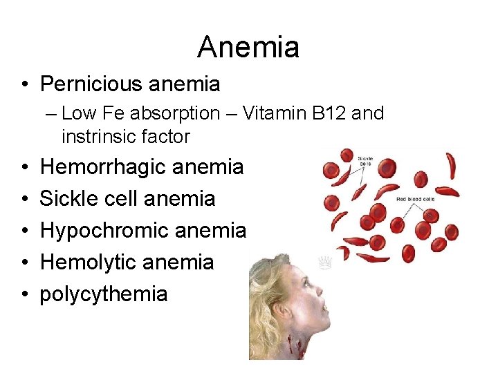 Anemia • Pernicious anemia – Low Fe absorption – Vitamin B 12 and instrinsic