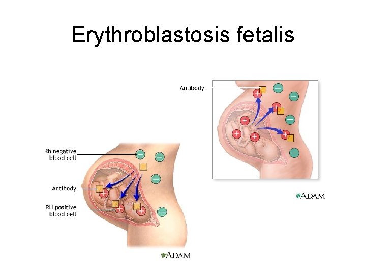 Erythroblastosis fetalis 