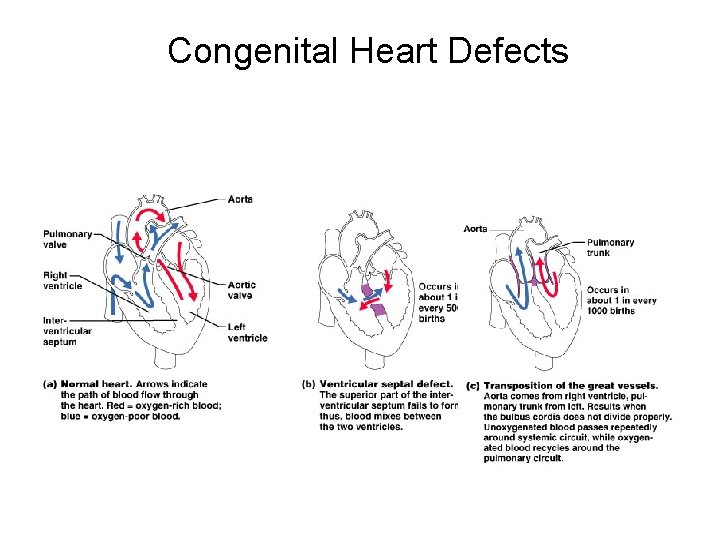 Congenital Heart Defects 