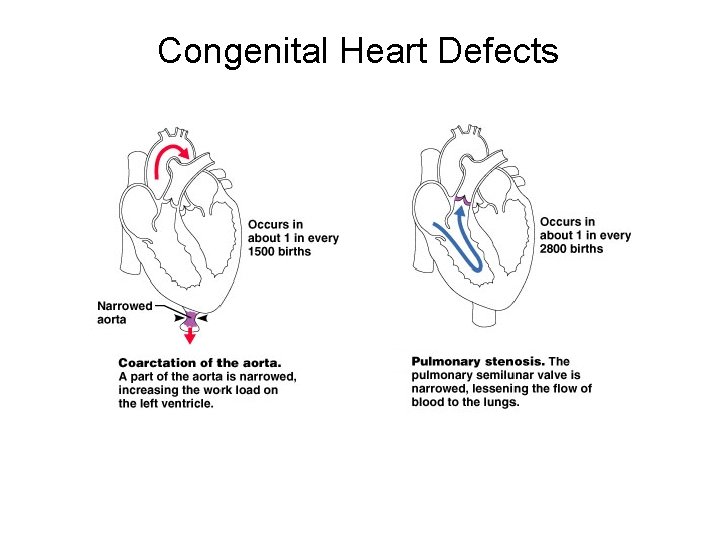Congenital Heart Defects 