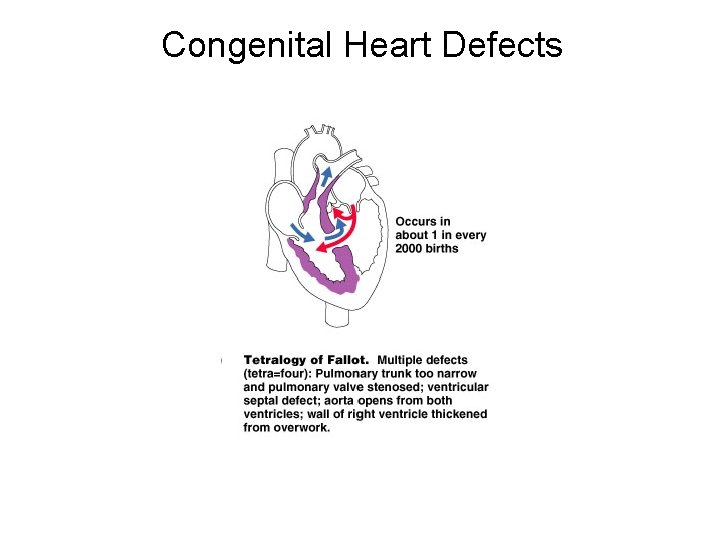 Congenital Heart Defects 