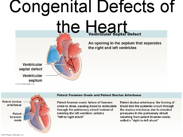 Congenital Defects of the Heart 