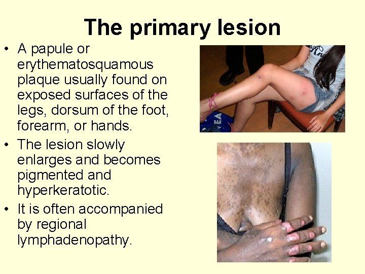 The primary lesion • A papule or erythematosquamous plaque usually found on exposed surfaces