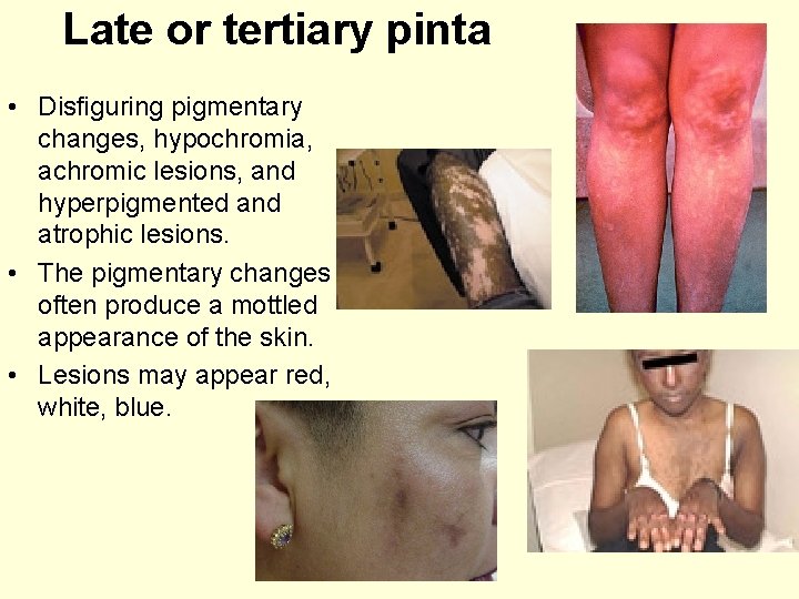 Late or tertiary pinta • Disfiguring pigmentary changes, hypochromia, achromic lesions, and hyperpigmented and