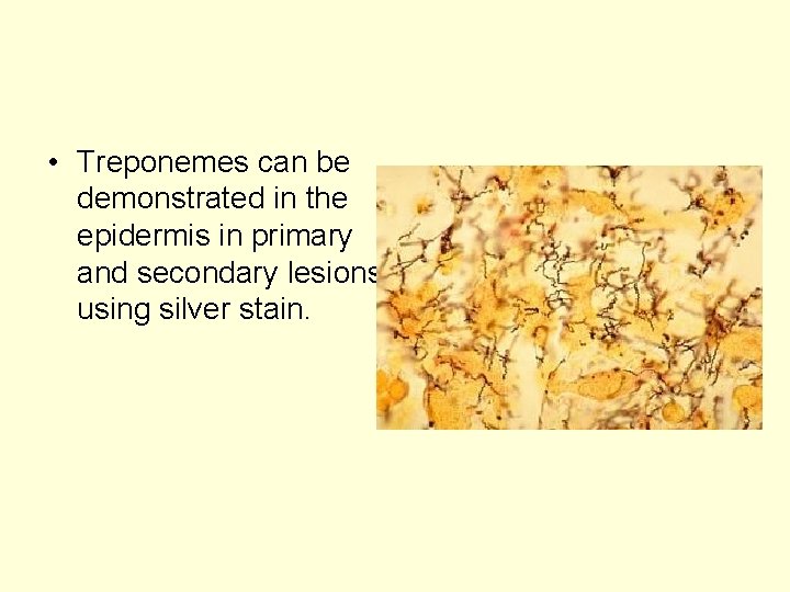  • Treponemes can be demonstrated in the epidermis in primary and secondary lesions
