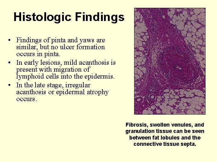 Histologic Findings • Findings of pinta and yaws are similar, but no ulcer formation