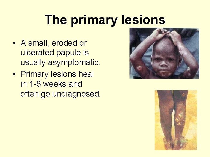 The primary lesions • A small, eroded or ulcerated papule is usually asymptomatic. •