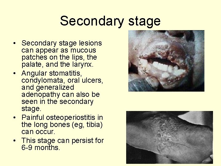 Secondary stage • Secondary stage lesions can appear as mucous patches on the lips,
