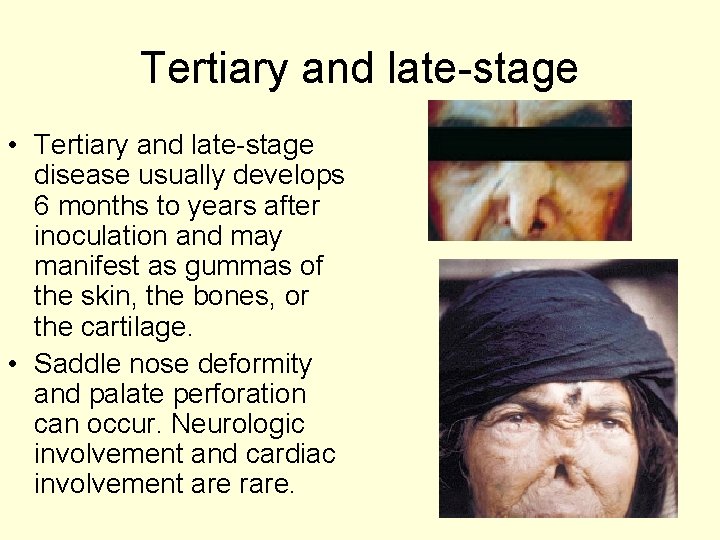 Tertiary and late-stage • Tertiary and late-stage disease usually develops 6 months to years