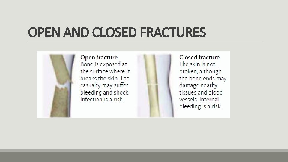 OPEN AND CLOSED FRACTURES 