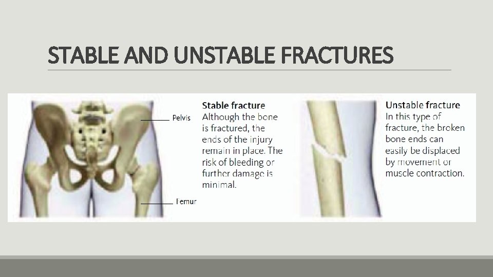 STABLE AND UNSTABLE FRACTURES 