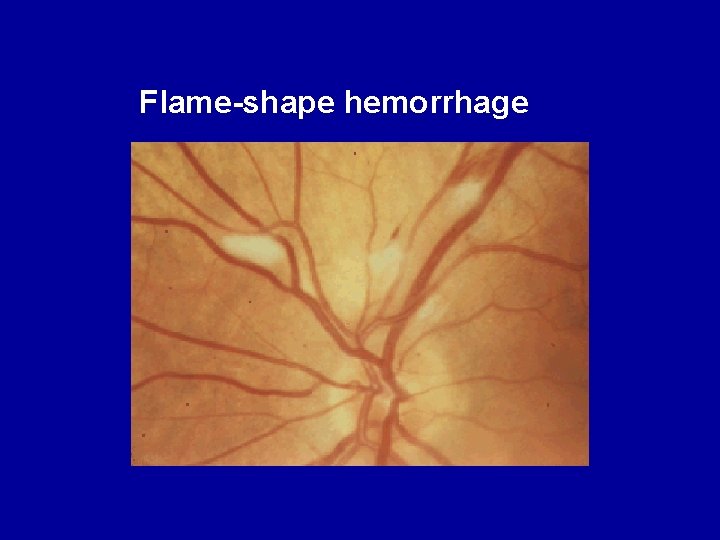 Flame-shape hemorrhage 