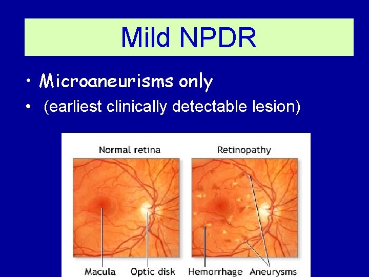 Mild NPDR • Microaneurisms only • (earliest clinically detectable lesion) 