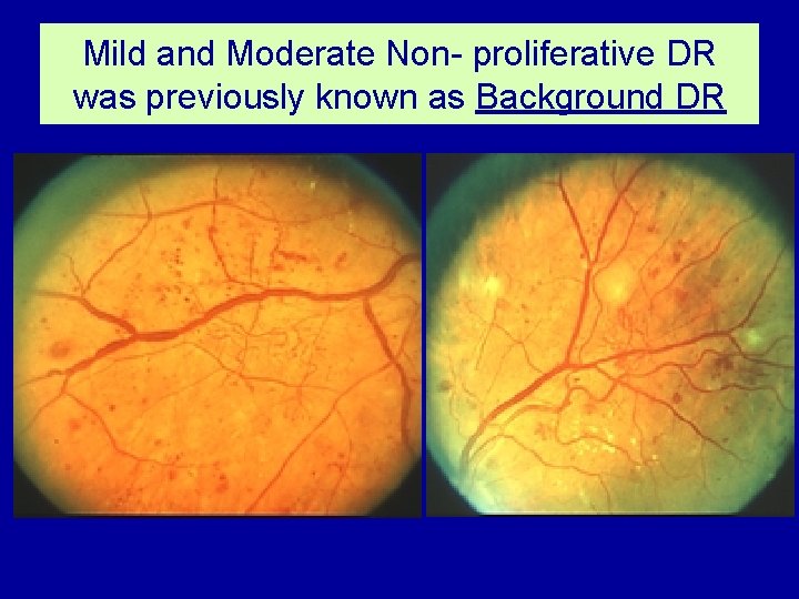 Mild and Moderate Non- proliferative DR was previously known as Background DR 