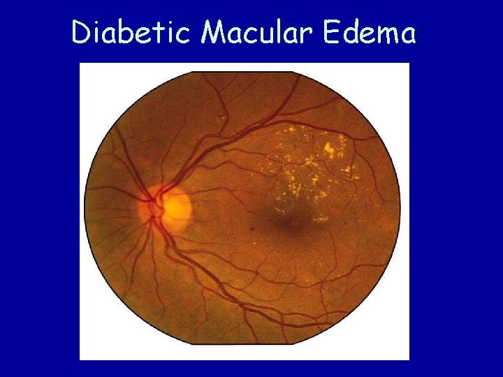 Diabetic Macular Edema 