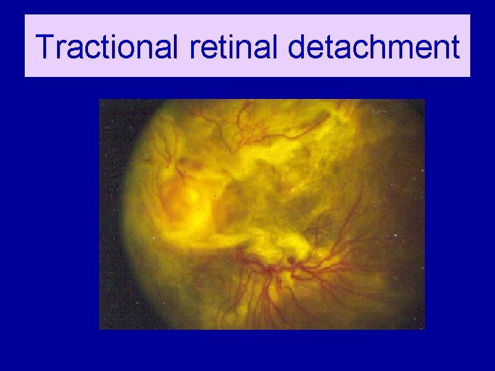 Tractional retinal detachment 