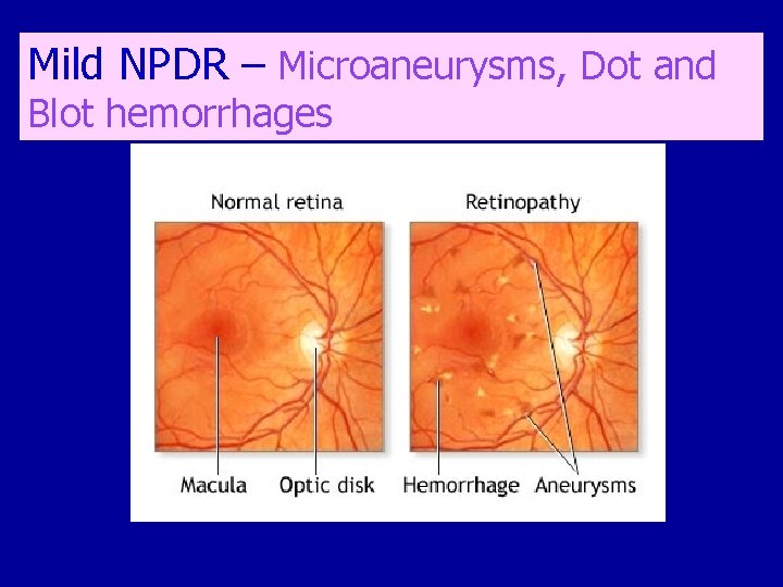 Mild NPDR – Microaneurysms, Dot and Blot hemorrhages 