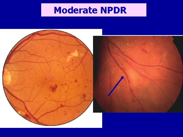 Moderate NPDR 