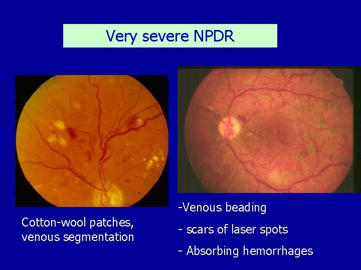 Very severe NPDR -Venous beading Cotton-wool patches, venous segmentation - scars of laser spots