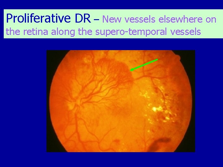 Proliferative DR – New vessels elsewhere on the retina along the supero-temporal vessels 